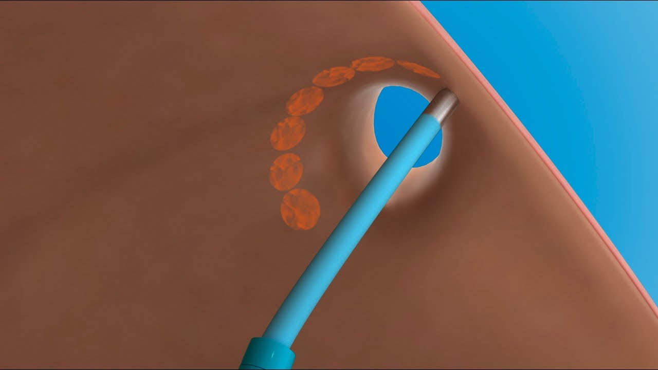Vorhofflimmern: Wie funktioniert eine Katheterablation?
