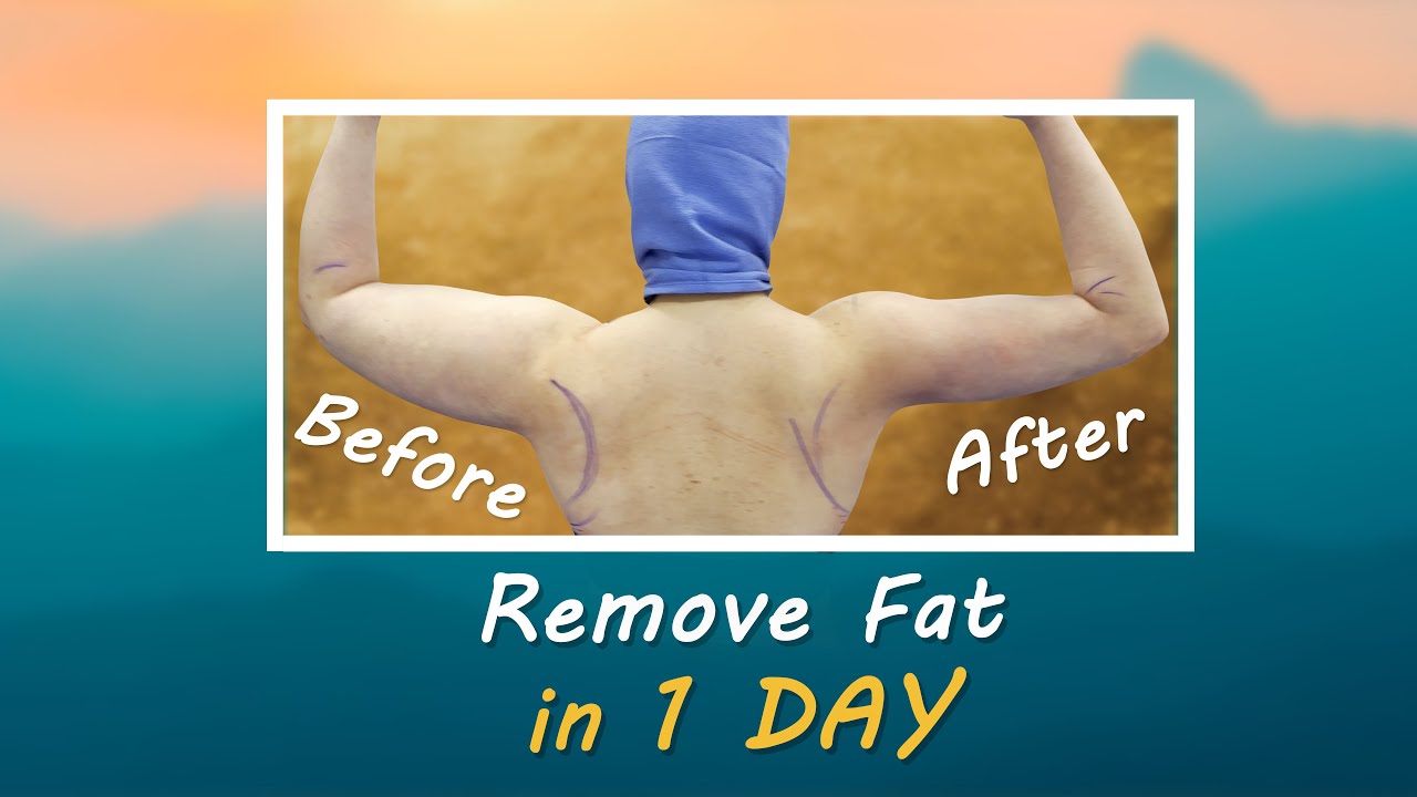 Celebrity Arms&trade; | Lipo 360&deg; Arms | Arm Liposuction Immediate Results| High Definition |Expert Dr. Su