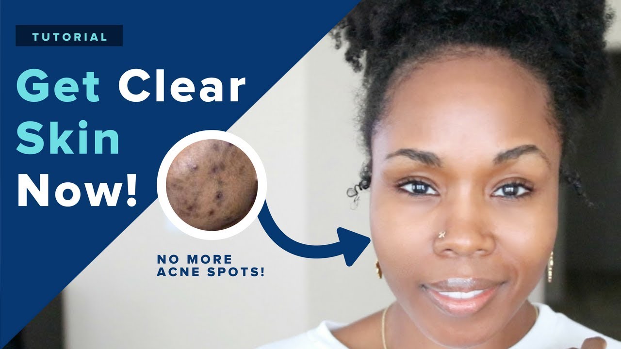 Get PERFECT CLEAR Skin in 1 Week NATURALLY! | 18 DIY Hacks That REALLY Work + CONTEST