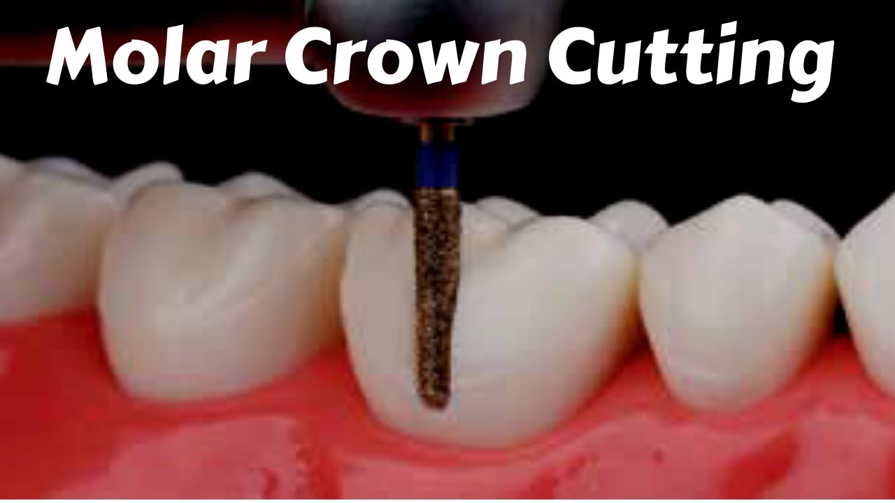 Posterior molar Crown #Tooth_Preparation Cutting For PFM Zirconia Ceramic Emax - Prostho Lecture