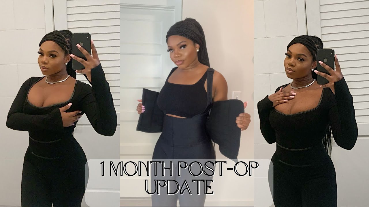 1 MONTH POST OP | LASER LIPO AT SONO BELLO