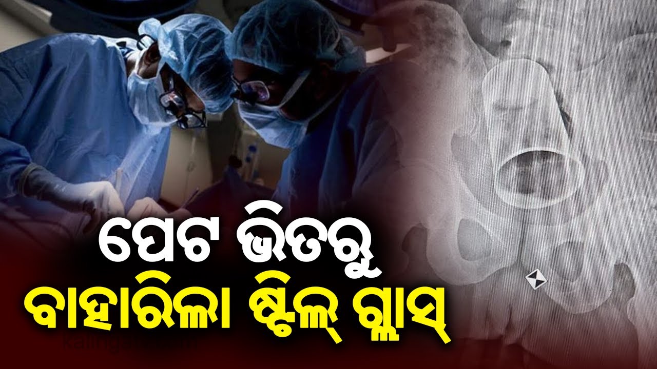 MKCG Doctors Stunned To Discover Steel Glass In Man's Stomach In Berhampur || KalingaTV
