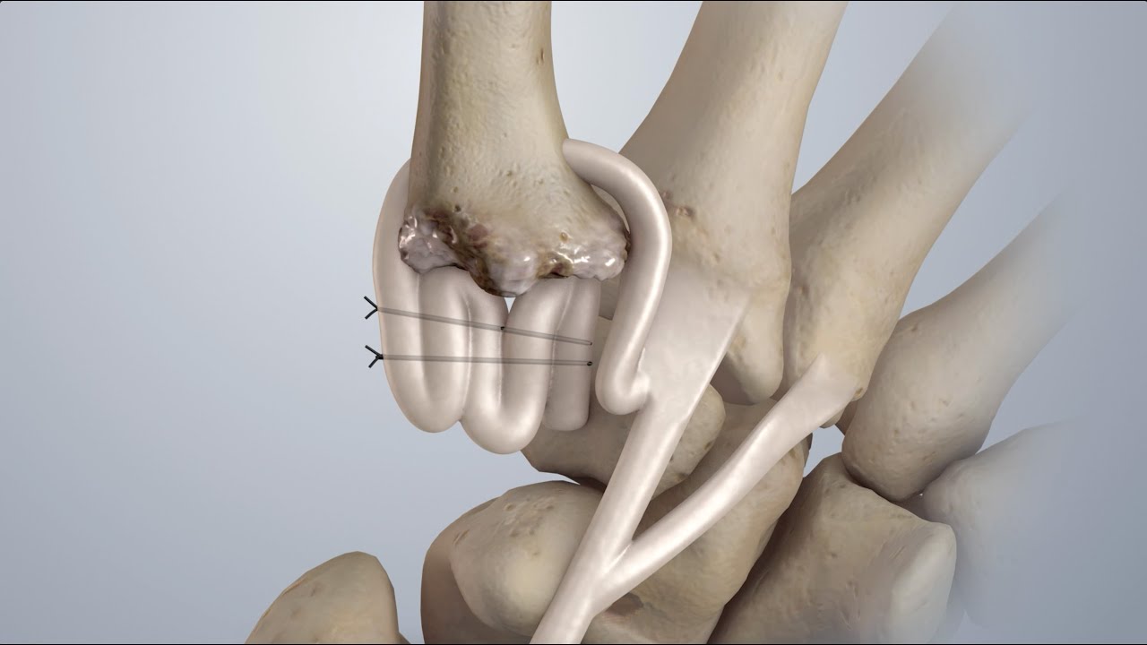 Osteoarthritis of the Thumb: Surgical Treatment (LRTI)