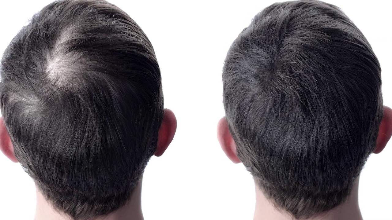 Can Blocking DHT Regrow Hair?