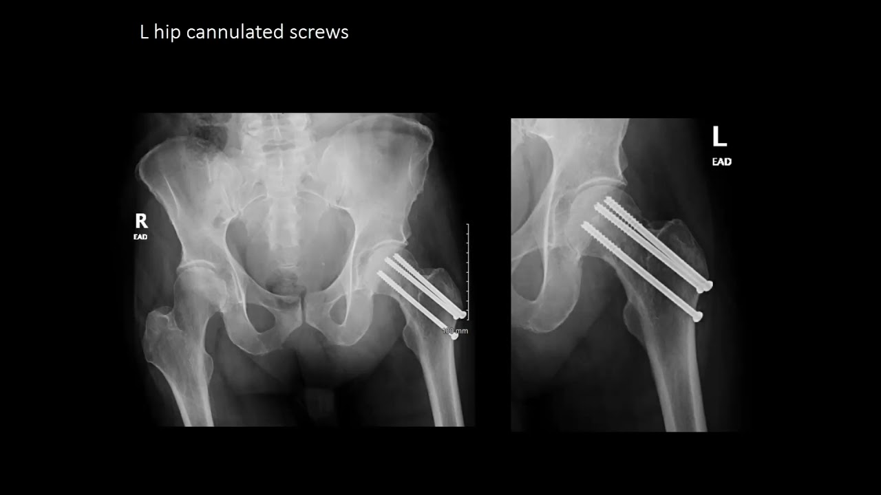 Fraction of Fracture - Displaced Femoral Neck Fracture, Dr. Alter