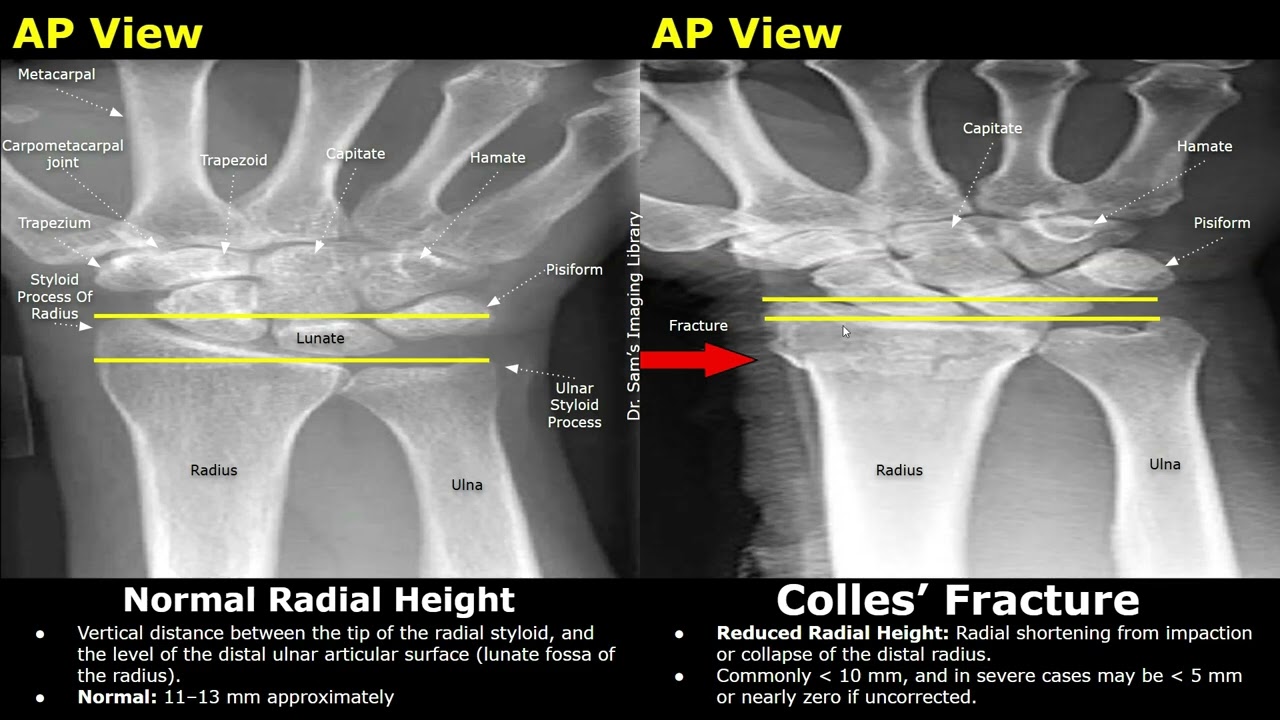 Wrist X-Ray Normal Vs Colles' Fracture | AP & Lateral Views | Distal Radius, Dinner Fork Deformity