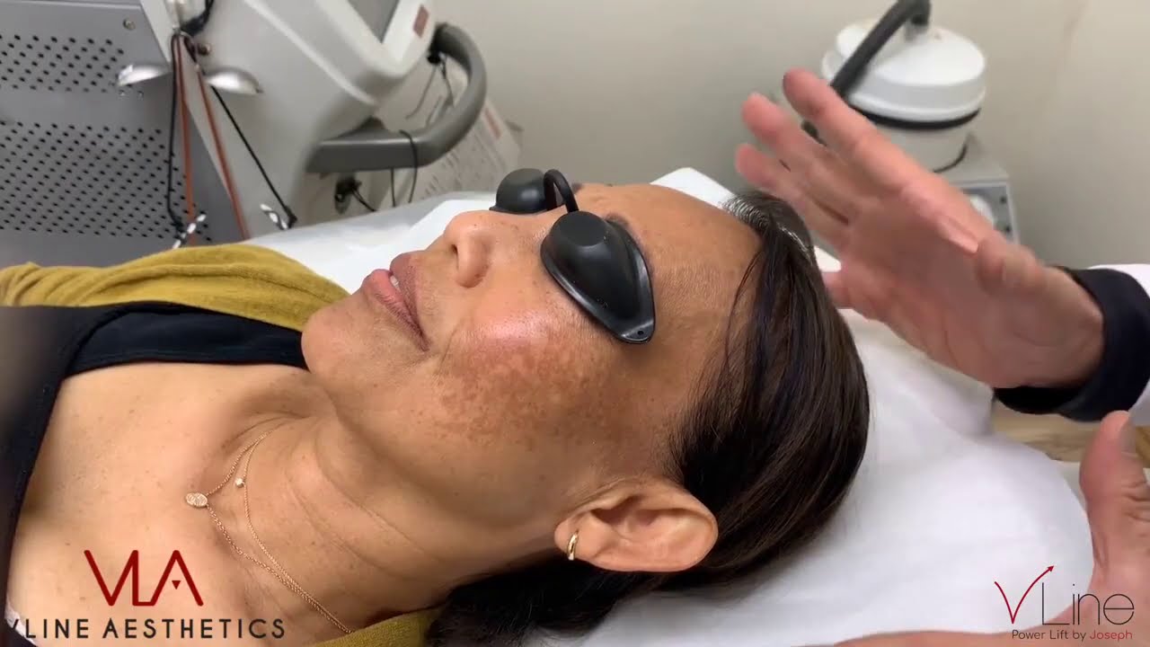 VLA Clarity Training : Melasma treatment Using Spectral Q wave
