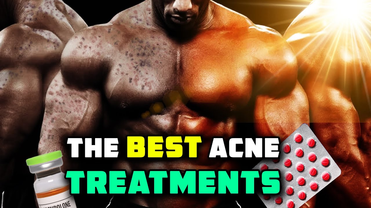 The MOST Effective Acne Treatments (for guys on gear AND nattys)