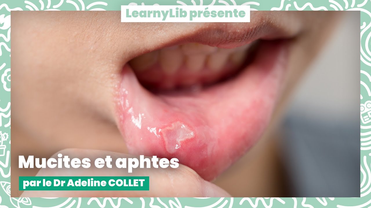 💊 Prévention de la dénutrition : les mucites et les aphtes avec le Dr Adeline COLLET