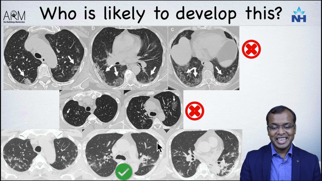 CT Imaging of Post COVID FIBROSIS