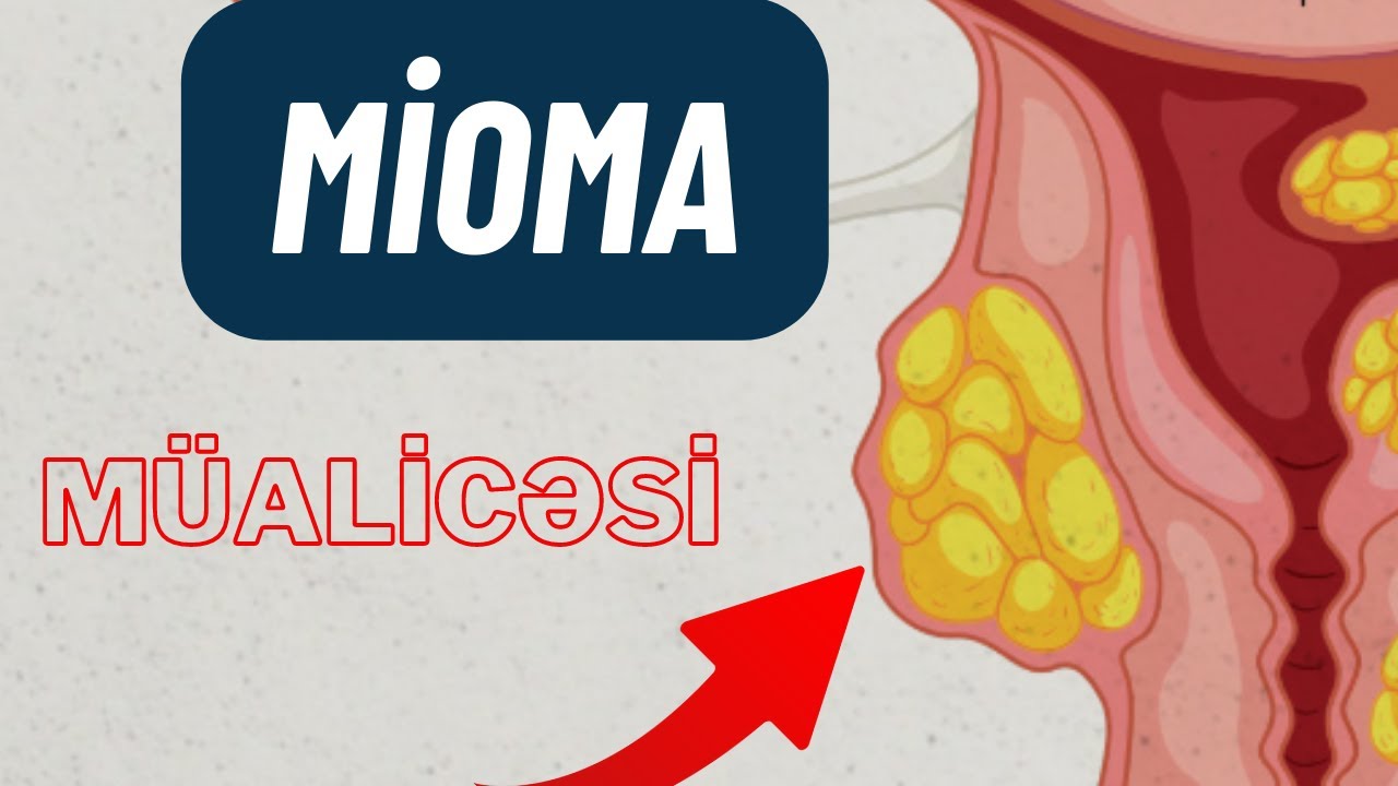 Mioma Necə Müalicə edilir? - Qadınlar İzləsin
