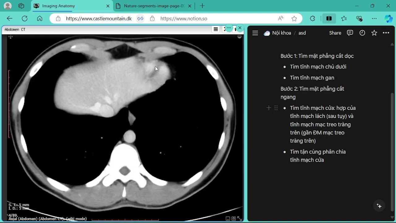 [LÂM SÀNG] Đọc CT scanner gan cơ bản | Tiêu hóa | Y3-6