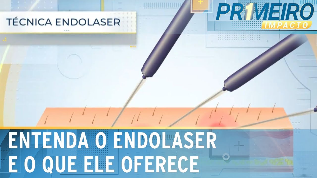 Entenda como funciona o endolaser e quais cuidados tomar | Primeiro Impacto (24/05/24)