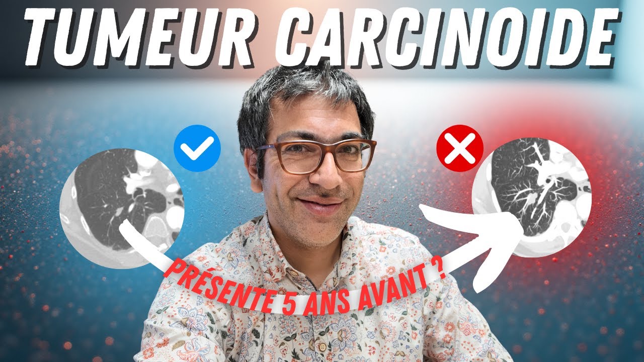 Diagnostiqu&eacute;e en 2025, mais d&eacute;j&agrave; pr&eacute;sente en 2020 ? Tumeur carcino&iuml;de de d&eacute;couverte fortuite