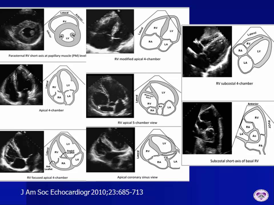 RV echo assessment