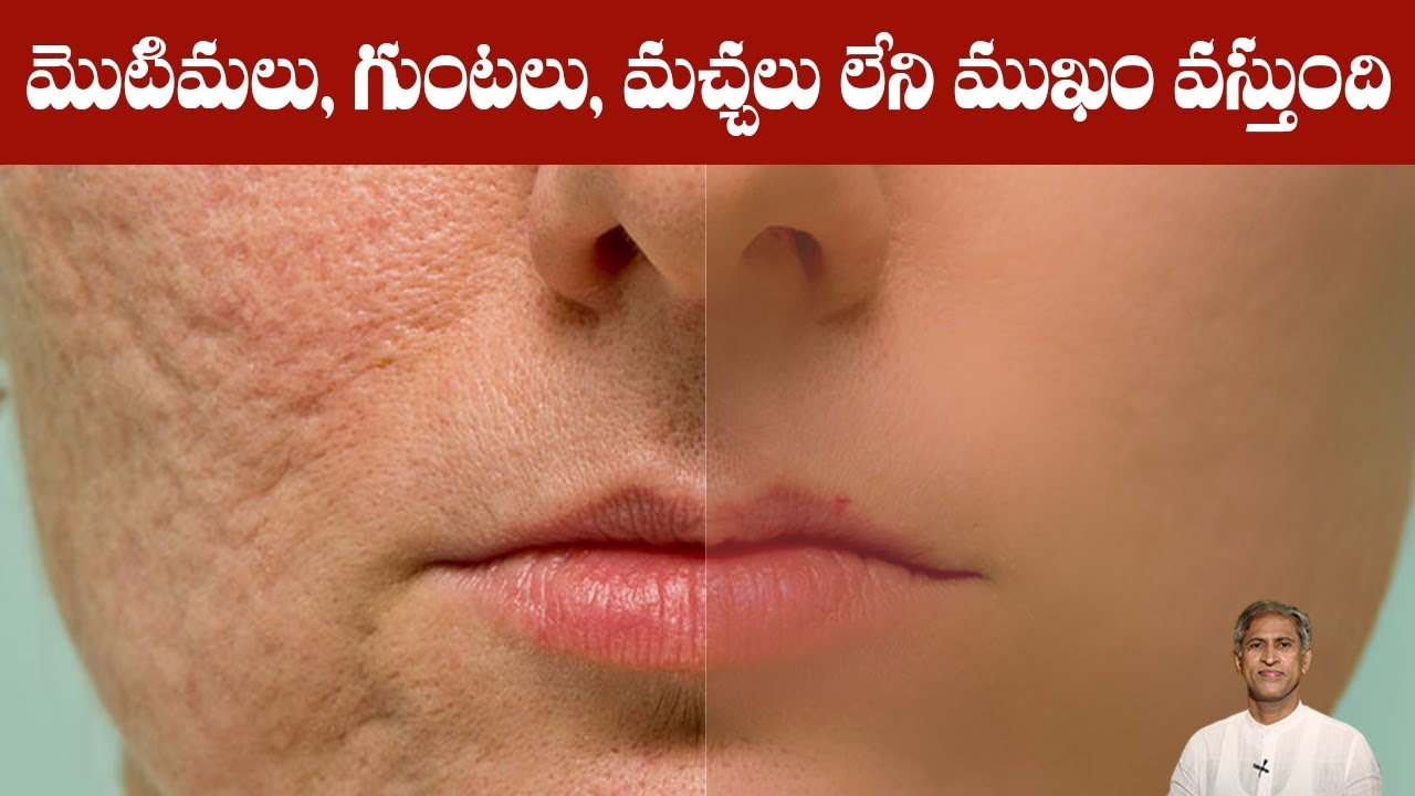 Tips to Remove Pimples and Acne Scars | Body Detoxification | Clear Skin | Dr.Manthena's Beauty Tips
