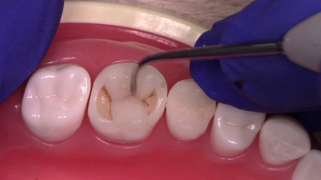 Resina Posterior Primer Molar Superior