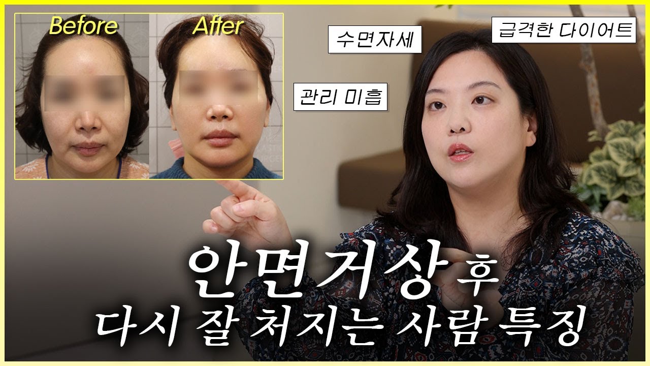 안면거상 수술했는데 벌써 처진다? 무너지는 얼굴의 결정적 이유