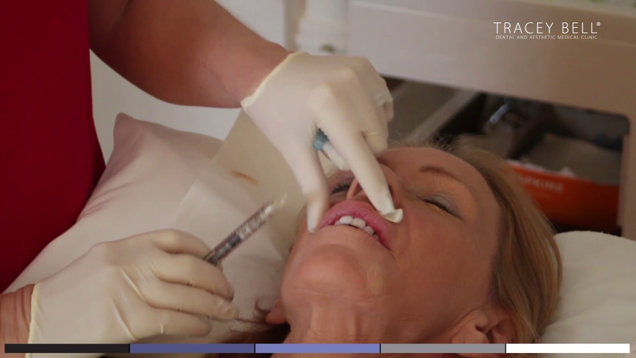 Juvederm Smile - how to enhance a lip naturally