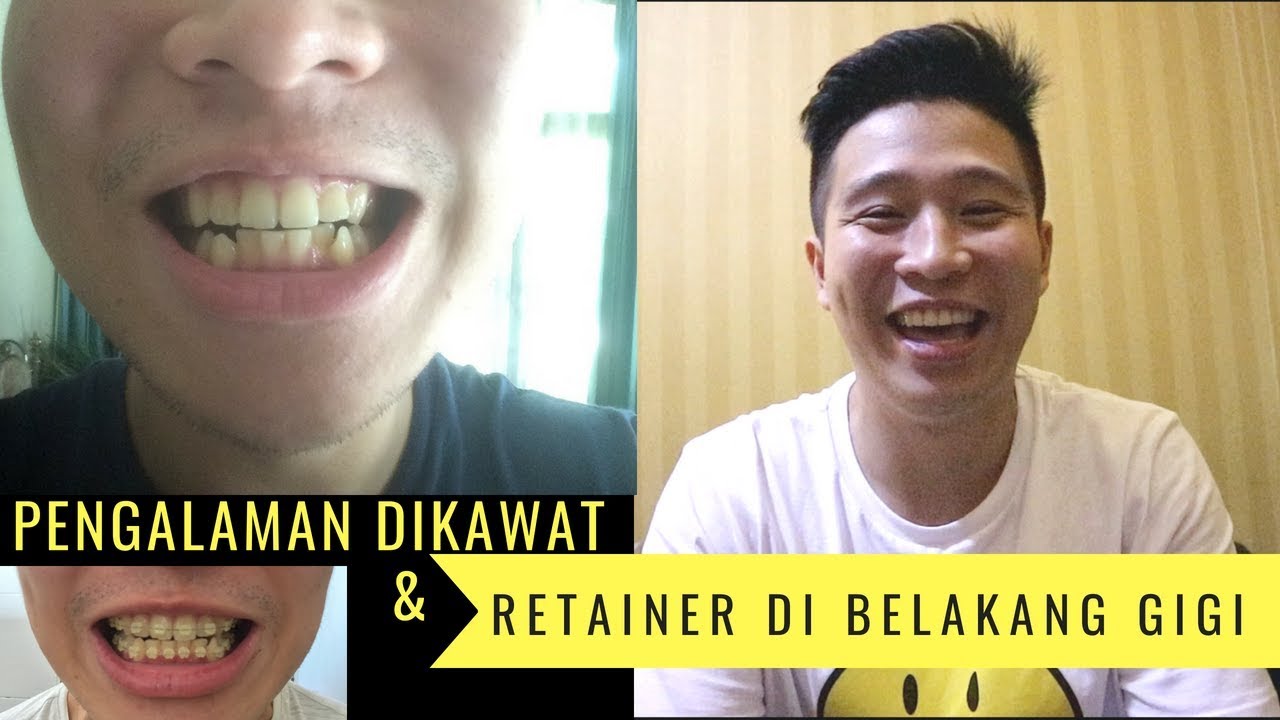 Pengalaman Dikawat dan Retainer yang di Belakang Gigi (GA KELIATAN)