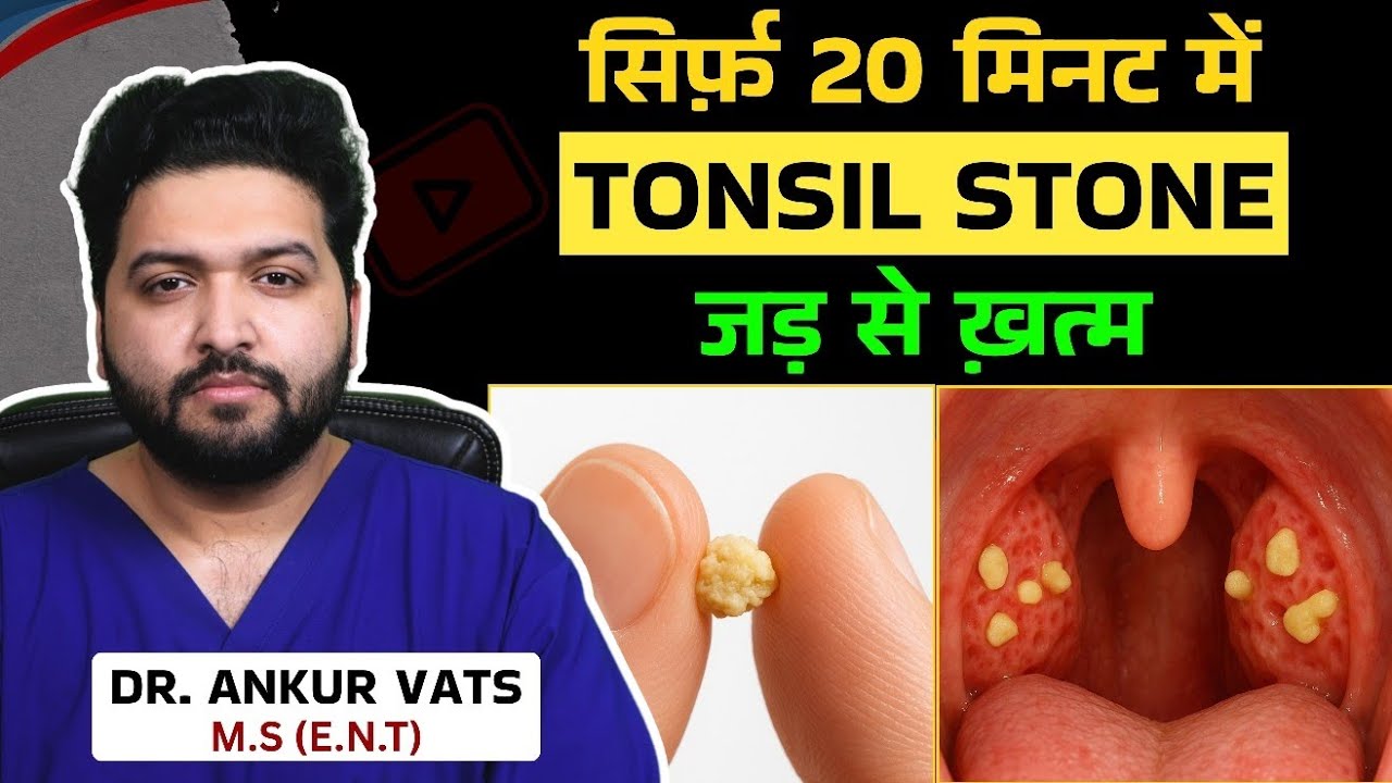 Tonsil Stone का Permanent इलाज सिर्फ़ 20 मिनट में! | Bad Breath की असली वजह |