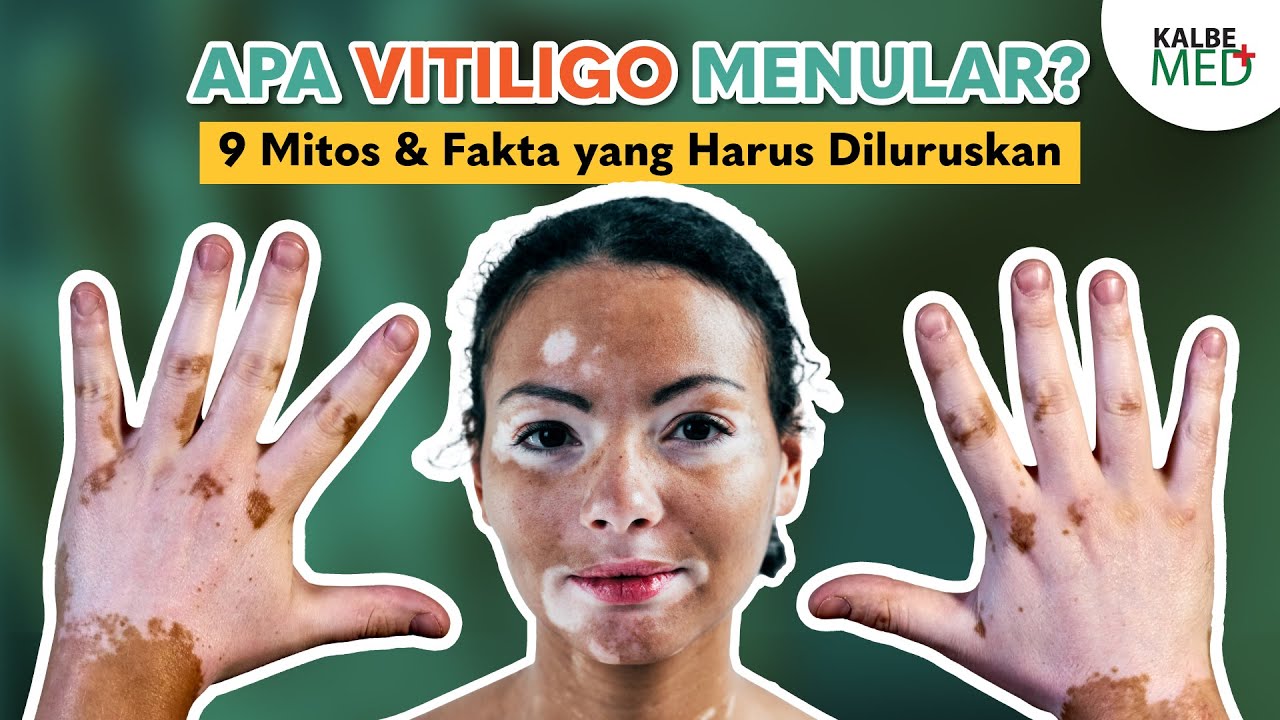 Apakah Vitiligo Menular? Getah Tumbuhan Obat Mujarab untuk Vitiligo? Kupas Tuntas Mitos & Faktanya!