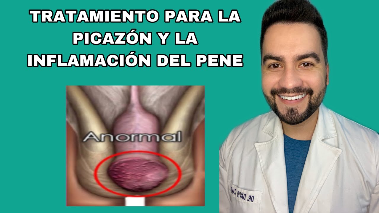TRATAMIENTO PARA LA BALANITIS / BALANOPOSTITIS / TENGO PICAZON EN EL P3N3 | DR. DAVID CAMPOS