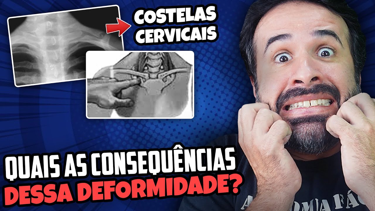 COSTELAS CERVICAIS QUAIS AS CONSEQUÊNCIAS DESSA DEFORMIDADE