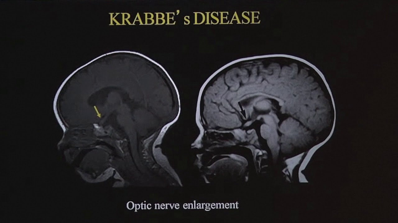 TMT: Neuroradiology by Dr Deepak Patkar: Ped White Matter Diseases - II