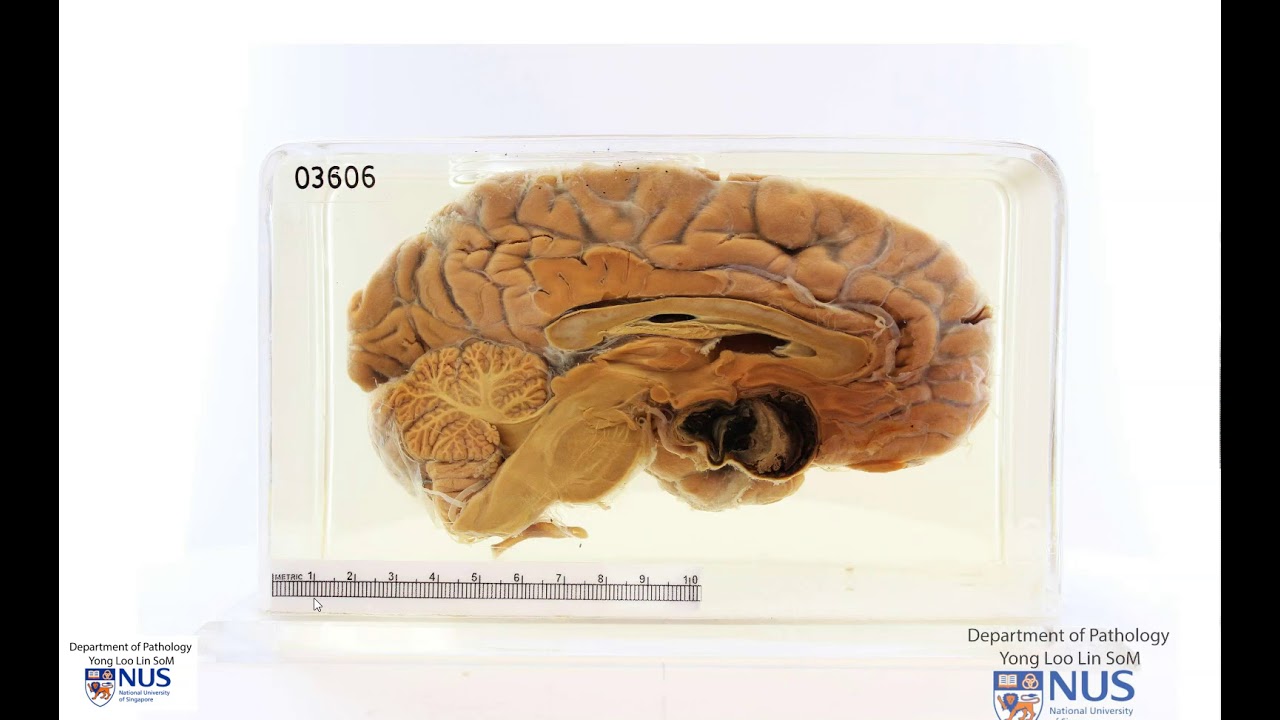 Brain: Berry aneurysm