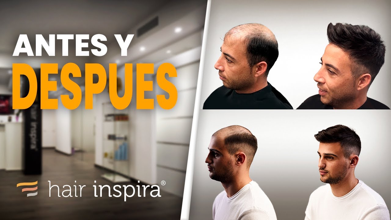 Resultados prótesis capilares indetectables / Before and after results hair system - Hair Inspira