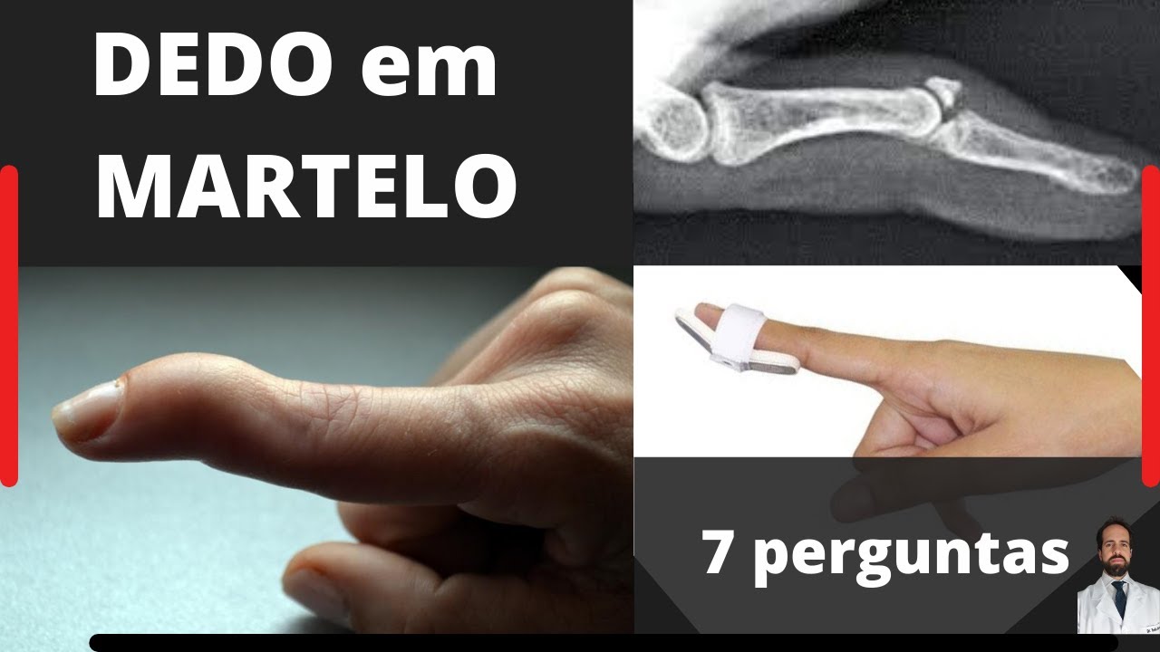 Dedo em Martelo - 7 perguntas