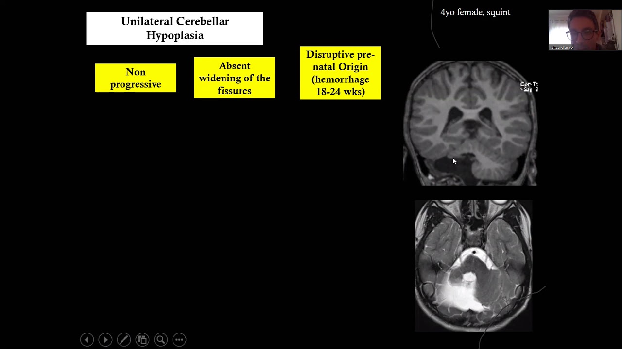 Pediatric Neuroradiology Lecutres: Posterior fossa malformations in children Dr Felice D'Arco