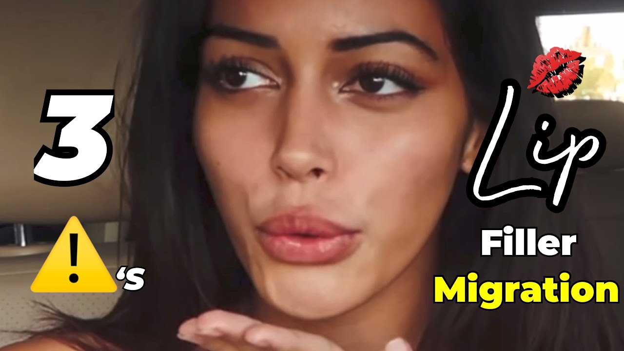3 признака миграции филлера для губ 