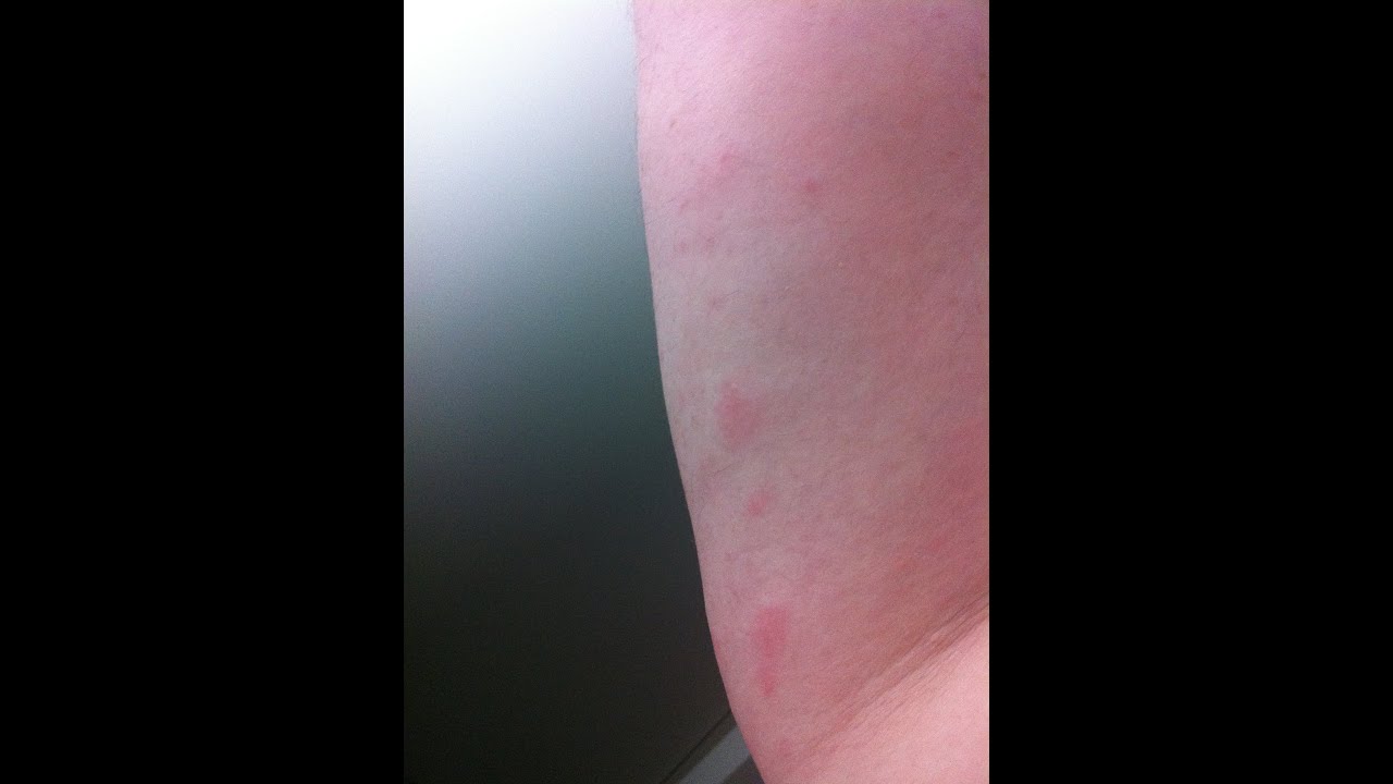 When BED BUGS Attack!!!!