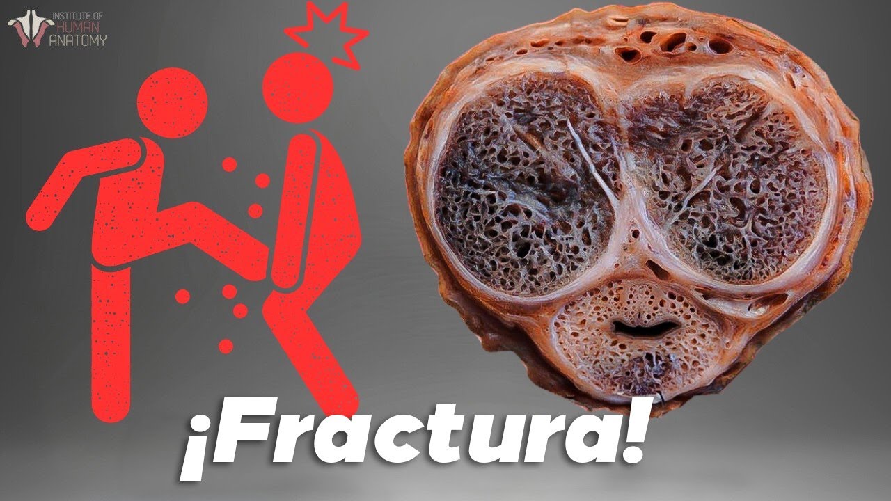 La Fractura Que No Quieres Conocer - Fractura De Pene Explicada