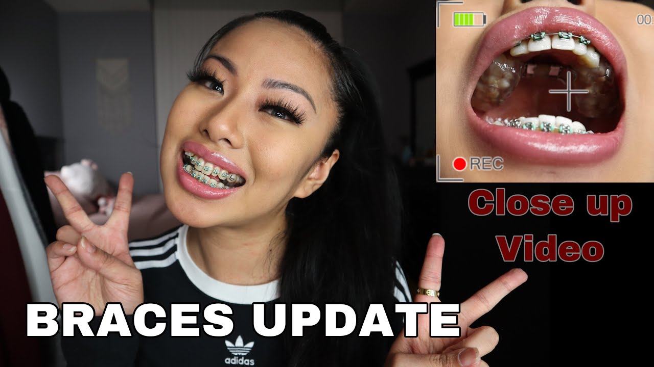 Braces update | Expander appliance close up video