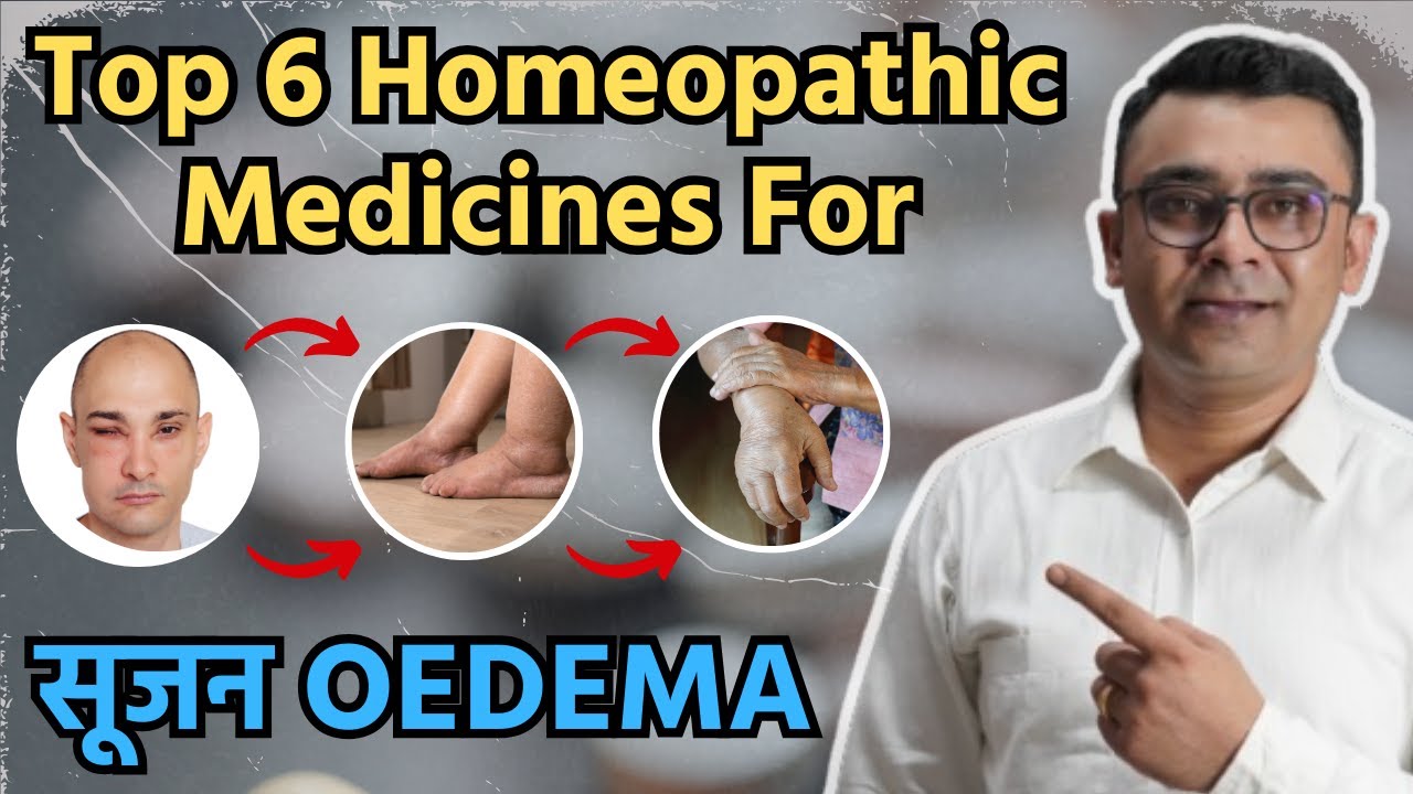 Top 6 Homeopathic Medicines for Oedema - #Swelling on Body