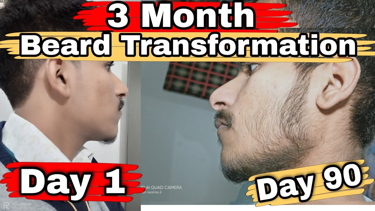 My 3 Month Complete Beard Transformation With Minoxidil🔥