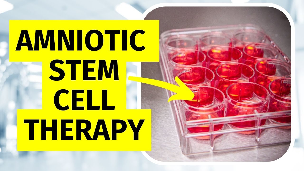 Amniotic Stem Cell Therapy for Knee Arthritis
