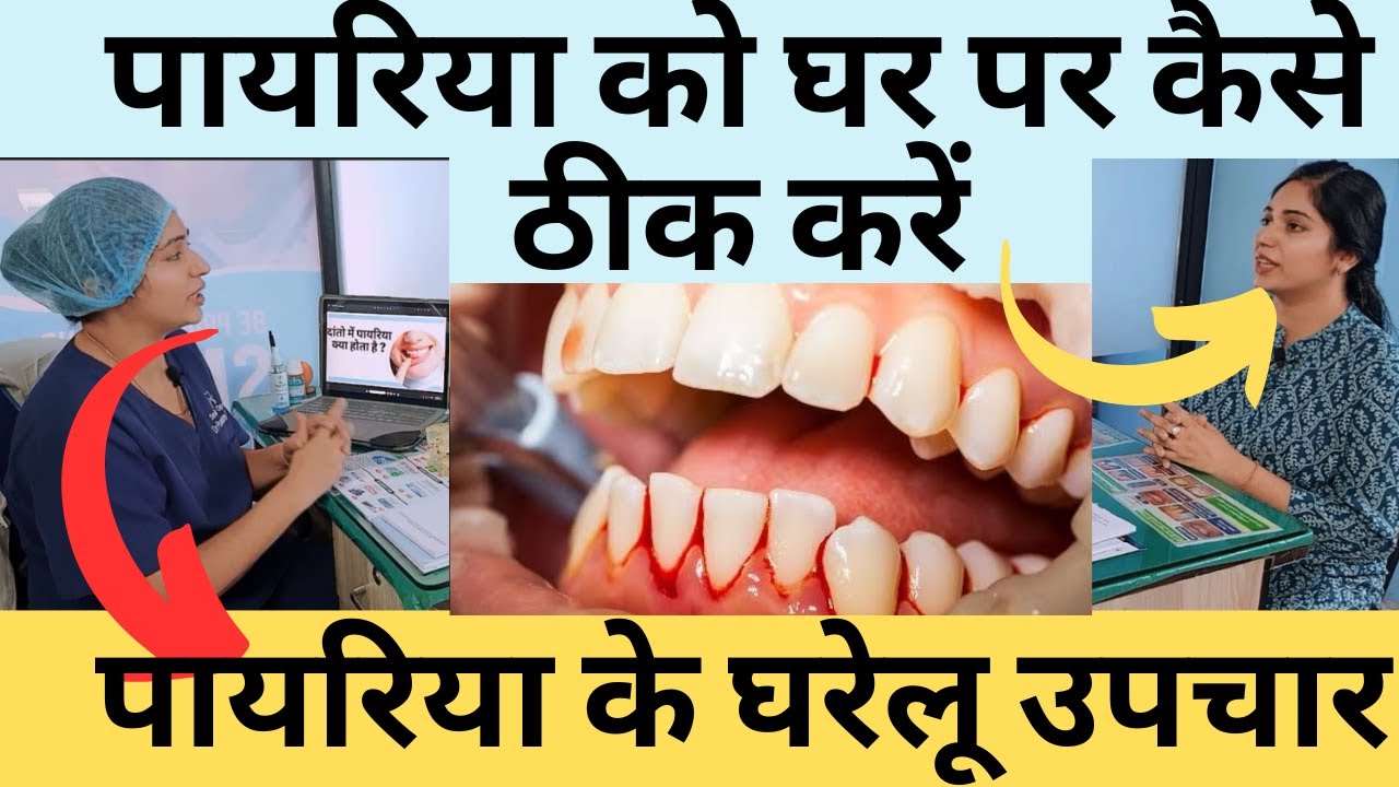 पायरिया का घरेलु इलाज | Pyorrhea Treatment At Home | Home Remedies For Periodontitis | #pyorrhea