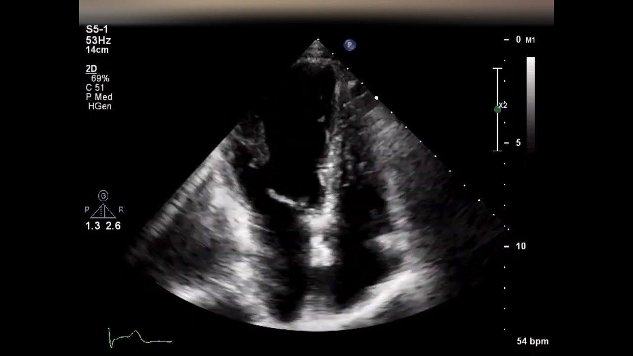 [Echo Case Review]small supracristal vsd
