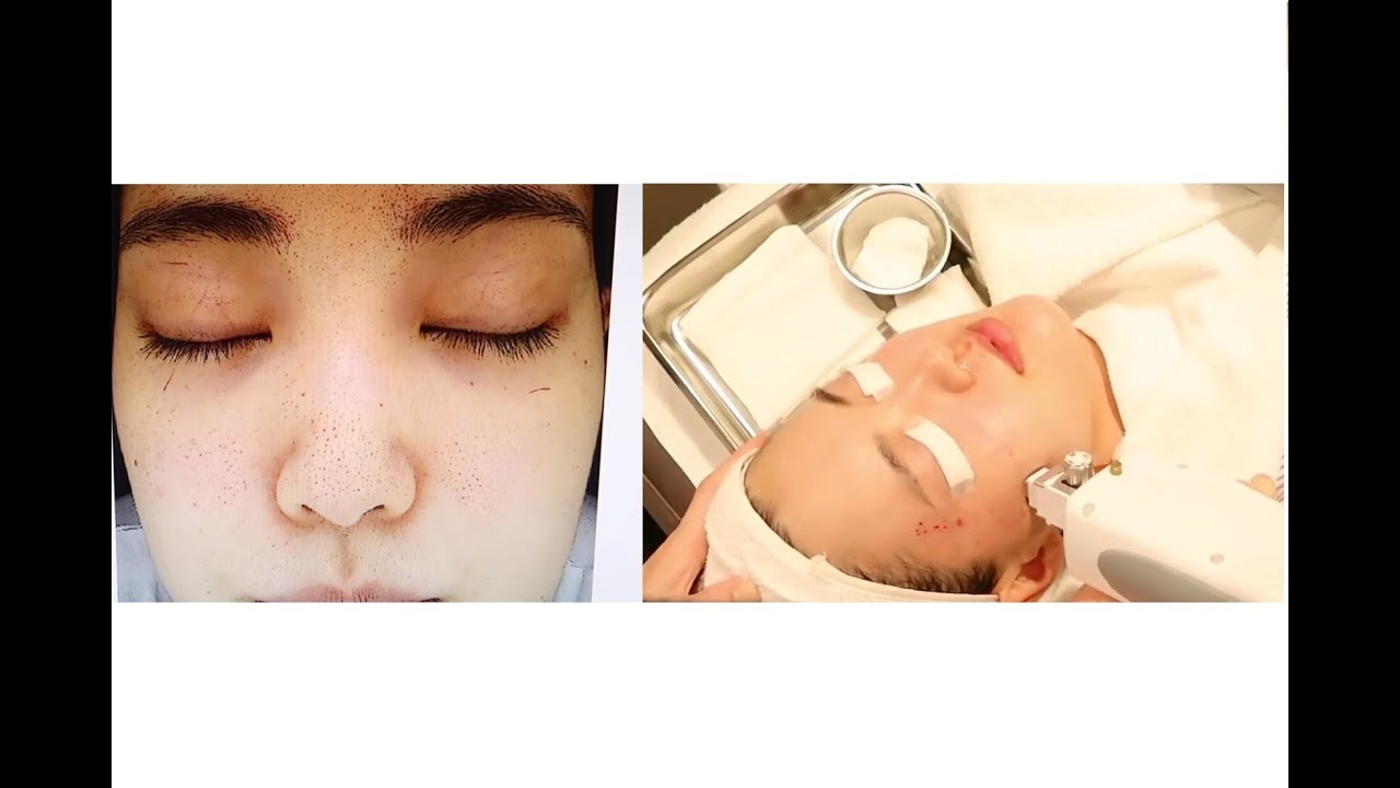 Michelle Choi gets Intracel Microneedling in Korea | Seoul Guide Medical