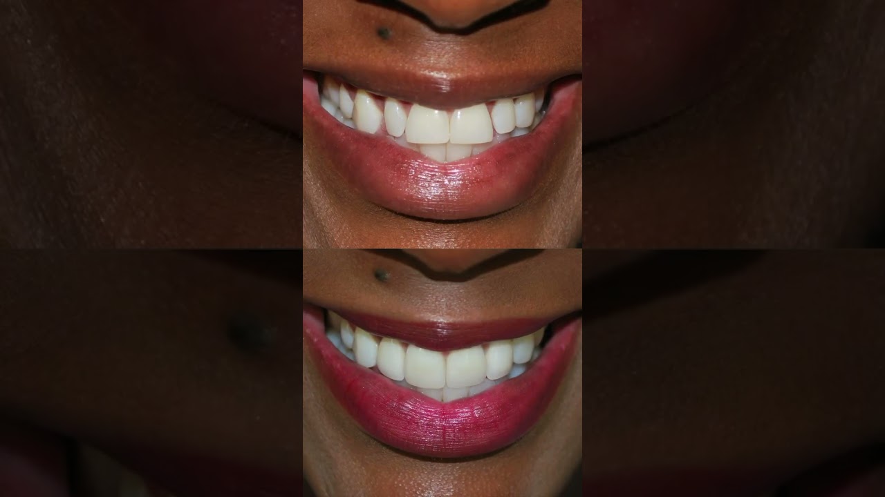 The power of veneers! MINT Dentistry Sexy Teeth before & after veneer cases #mintdentistry #veneers