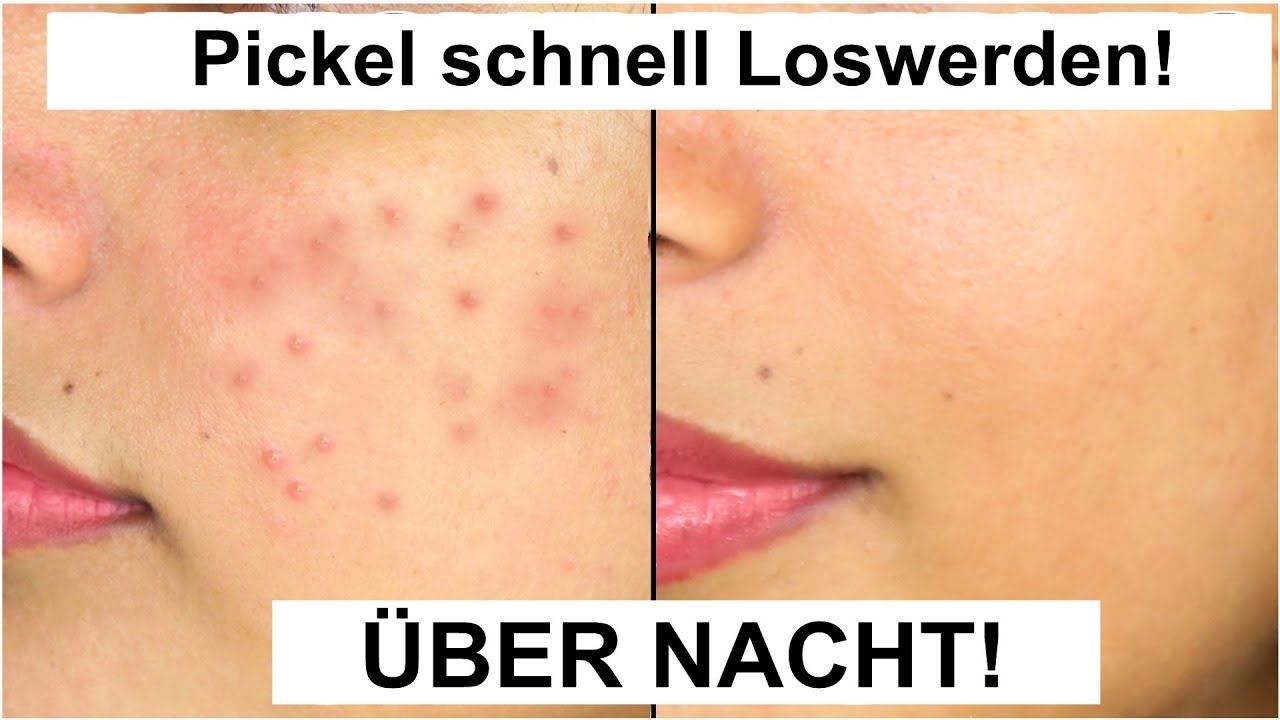 4 Hausmittel, mit denen du PICKEL &uuml;ber NACHT loswirst!