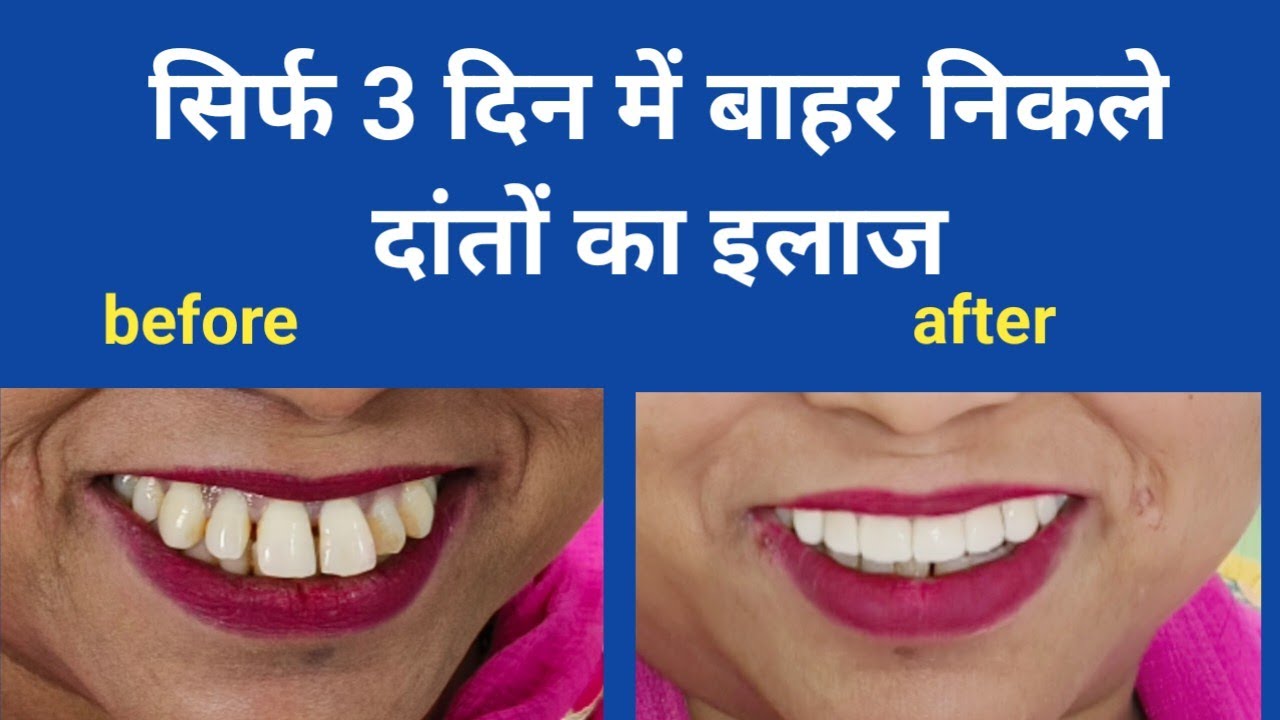 बाहर निकले दांतों का इलाज सिर्फ 3 दिन में// before and after smile transformation just in 3 days