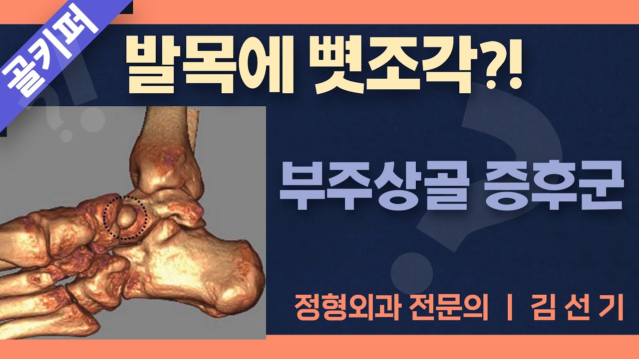 발 뼈가 선천적으로 유합되지 않았다면?
