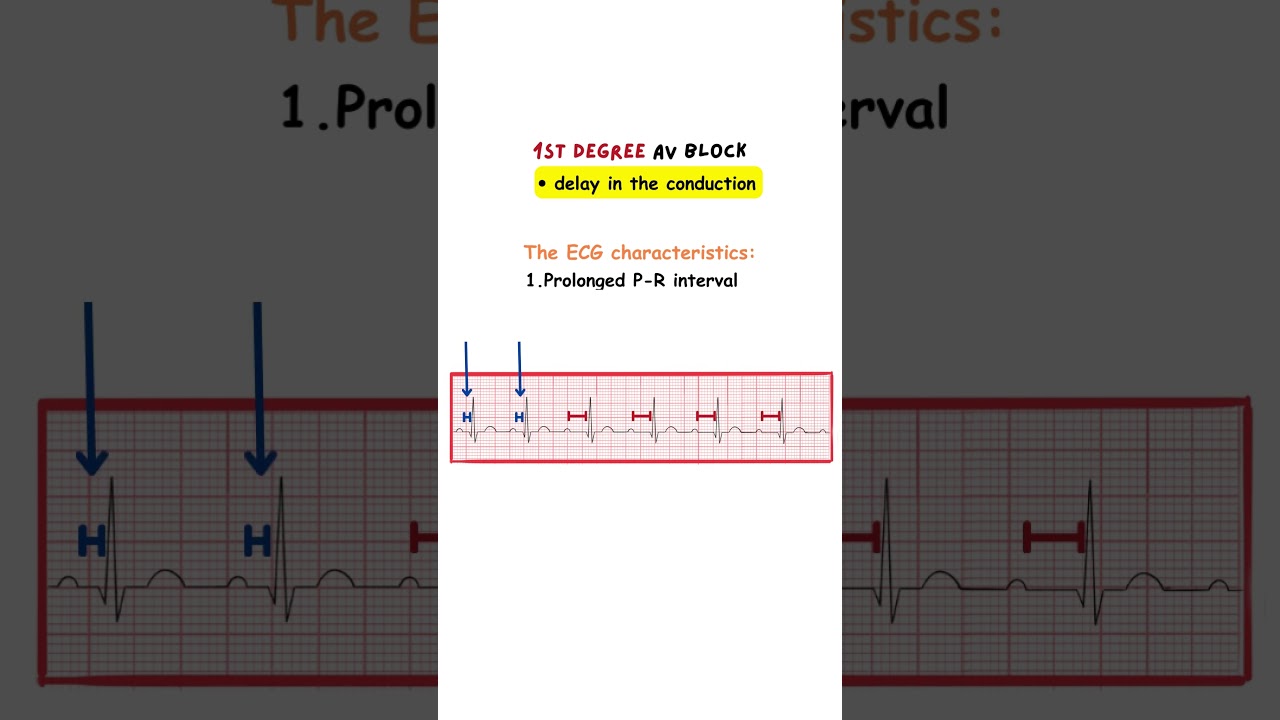 AV Node Blocks- 1st degree #ecg #medicine #medicalstudent #medicaleducation #medical #doctor #nurse