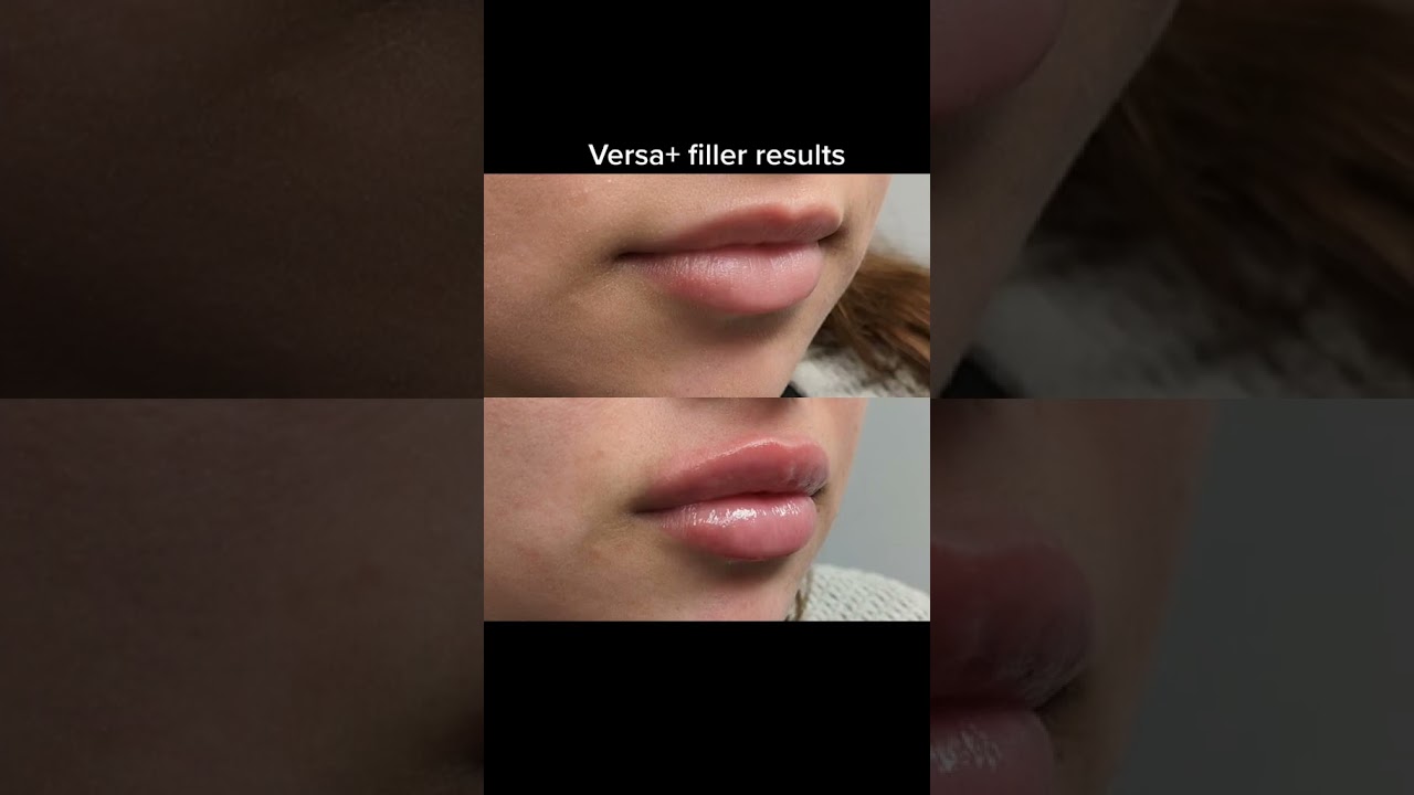 Beautiful lip filler result with Versa filler. #fillers