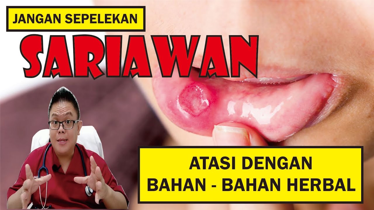JANGAN SEPELEKAN SARIAWAN............... ATASI DENGAN BAHAN -BAHAN HERBAL